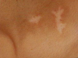 到处都是白斑?什么是泛发型的白癜风症状