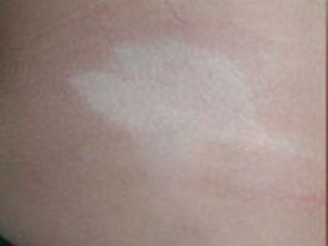 ºÃ¶àÃÀζ¼ÑëȲ»ÄܳÔ!·º·¢ÐͰ×ñ°·ç»¼ÕßÐè¼É¿Ú